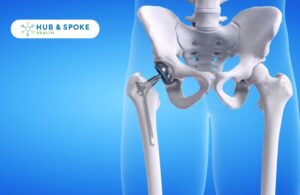 Preparing for Total Hip Replacement | Hub and Spoke Health