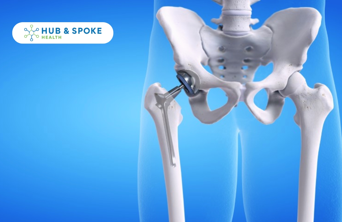 Preparing for Total Hip Replacement | Hub and Spoke Health
